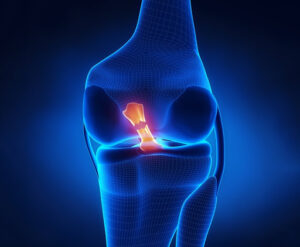 Lesione legamento crociato anteriore