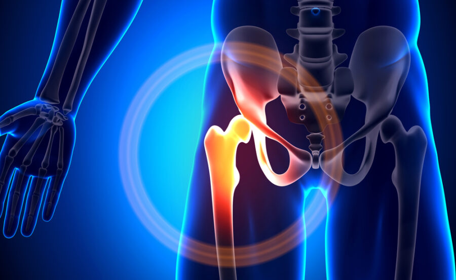 Impingement femoro-acetabolare a carico dell'anca