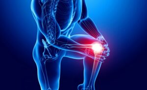 Paziente affetto da inibizione muscolare artrogenica